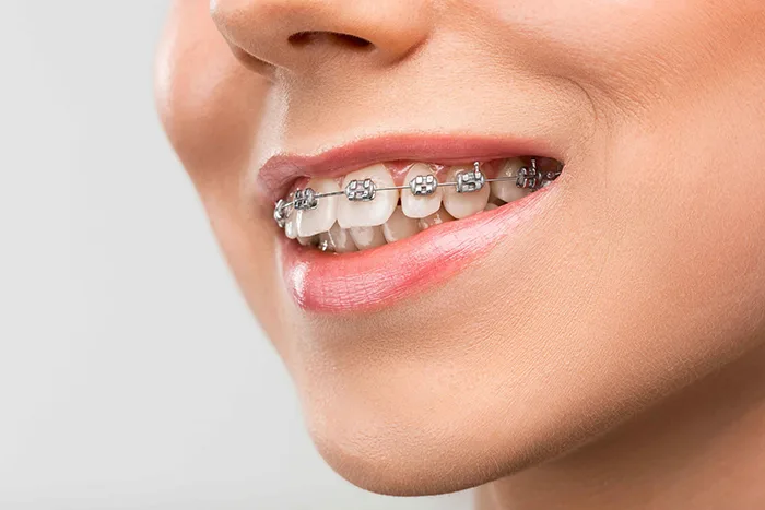 braces