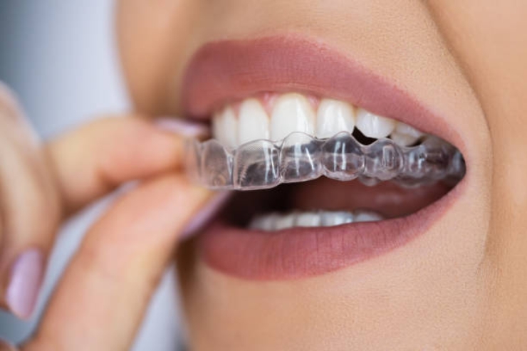 Aligners-22
